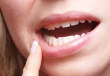 7 Natural Remedies To Treat Sores In The Mouth