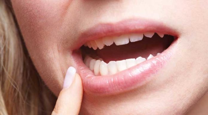 7 Natural Remedies To Treat Sores In The Mouth