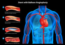 Clotting of the heart stent – is it possible?