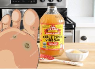 Eliminates ALL Warts With These Three Recipes With Garlic