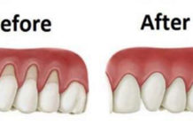 Natural Cures for Receding Gums