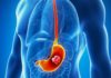 The Scientist Found That This Vitamin Prevents The Risk Of Stomach Cancer