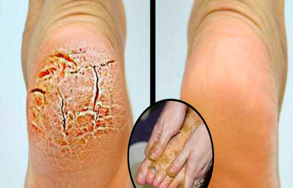 My Mother Did This When Her Heels Were Cracked. I Did Not Mention It Until I Tried It Myself