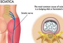 8 Natural Remedies For Sciatic Pain