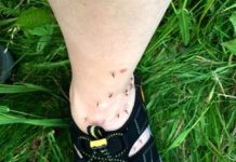 The Surprising Reasons Why Mosquitoes Bite Some People and Don’t Touch Others