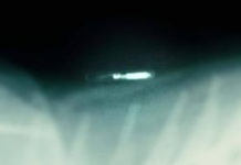 Doctor Extracts RFID Chip From Sex Trafficking Victim