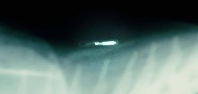 Doctor Extracts RFID Chip From Sex Trafficking Victim