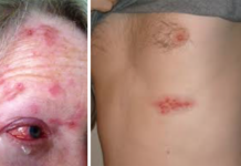 New Study: Chickenpox Vaccine Linked to Widespread Increase in Shingles